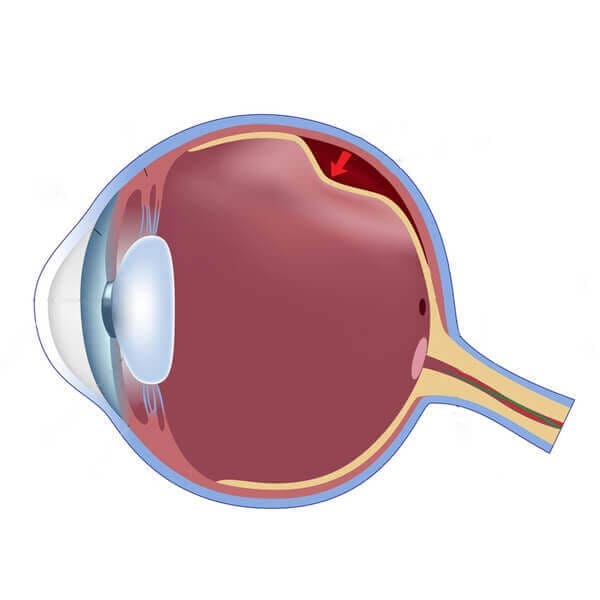 Retina Specialist - Retinal
                    Detachment