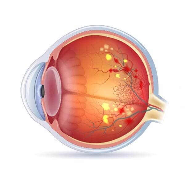 Retina Specialist -
                    Diabetic Retinopathy